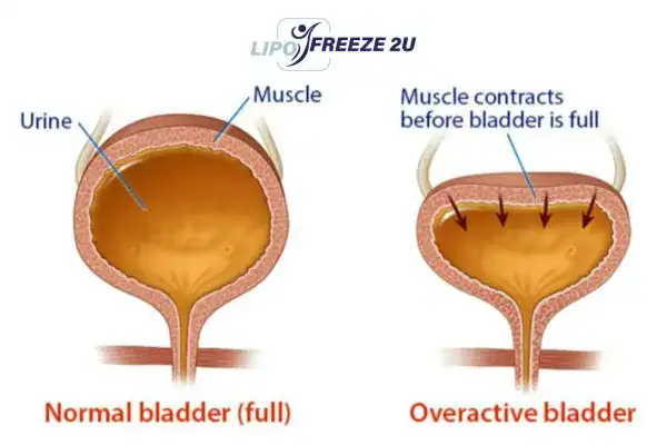 diagram of overactive bladder treatment Bury St Edmunds