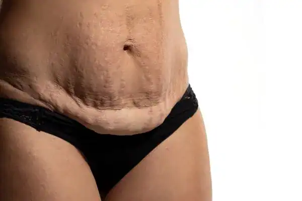 loose skin after weight loss injections Bury St Edmunds
