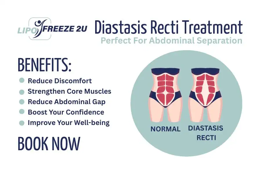 How Long Will It Take to See Improvements in Diastasis Recti Bury St Edmunds