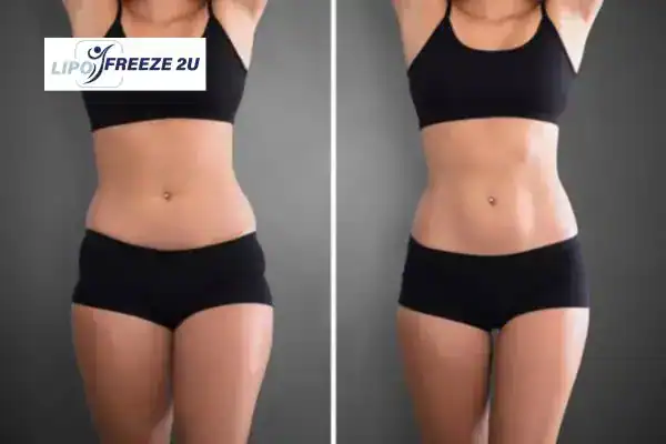 How Can LIPO FREEZE 2U Support Your Post-Pregnancy Body Recovery Bury St Edmunds?