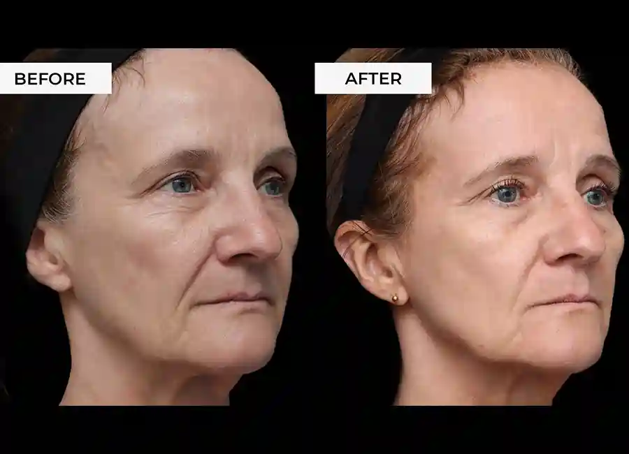 How Many RF Microneedling Sessions Will You Need to See a Difference Bury St Edmunds?